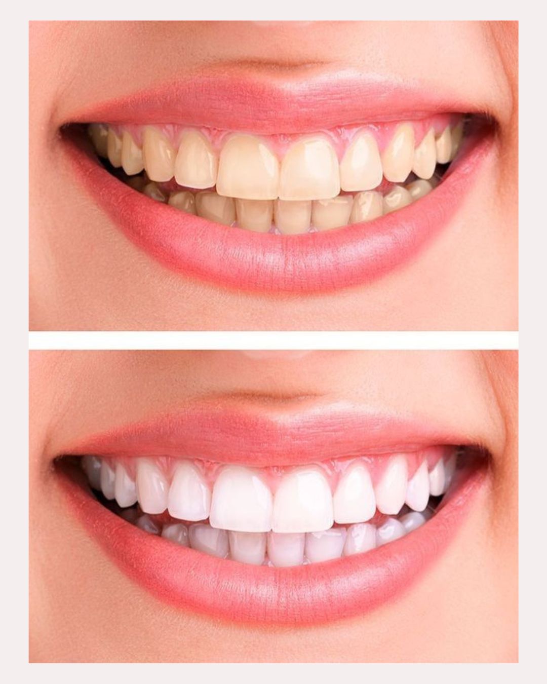 Blanqueador Dental BrightSmile®